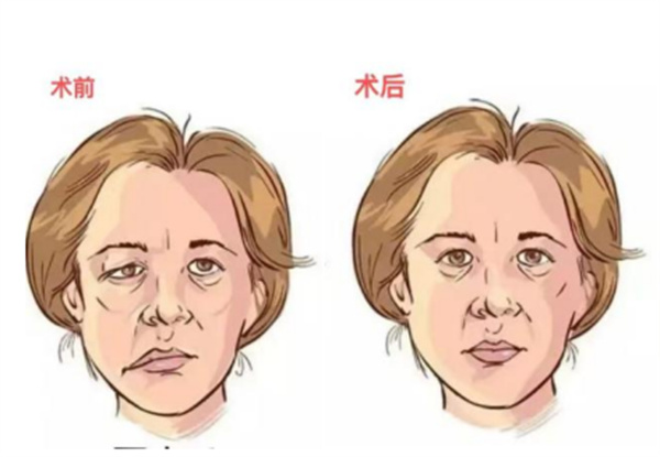 CT引導(dǎo)下面神經(jīng)脈沖射頻治療面癱取得顯著成效